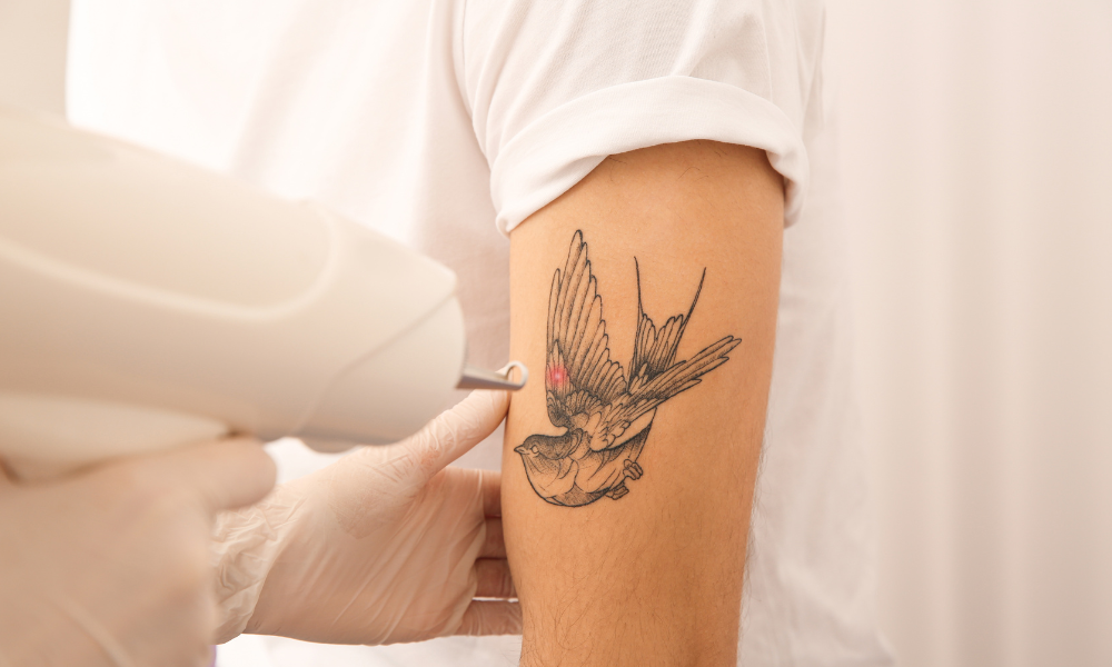 tattoo removal clinic near me