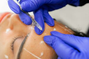 Dermal Fillers