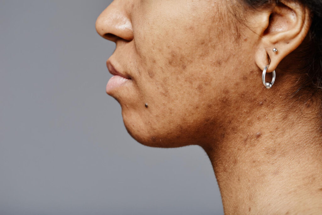 Dark Spots