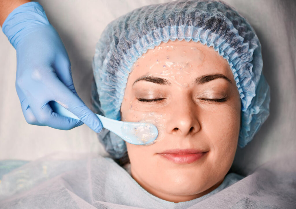 chemical peel