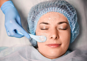 chemical peel