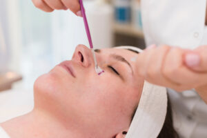 chemical peel