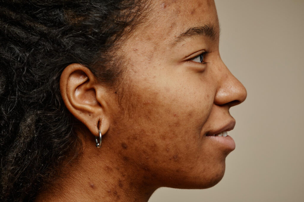 dark spots
