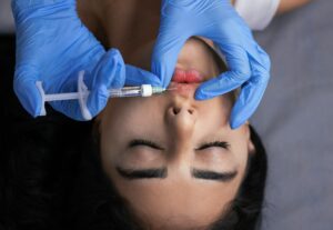 Hyaluronic Acid Fillers