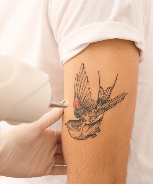 tattoo removal clinic near me